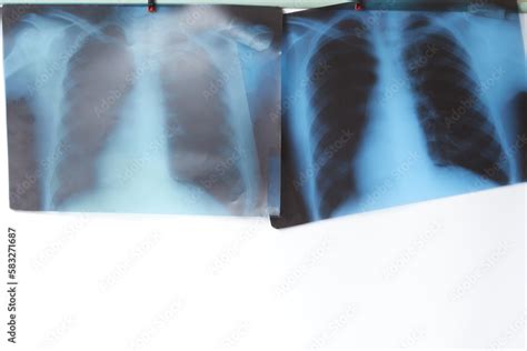 X-ray diagnostic panel with lung x-rays and lung x-rays. Examining X ...