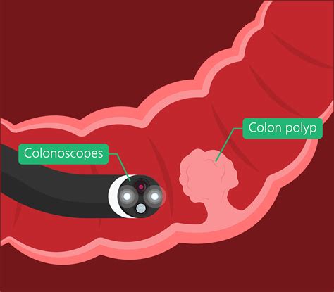 Emr Polypectomy Dubai Gastroenterology Clinic