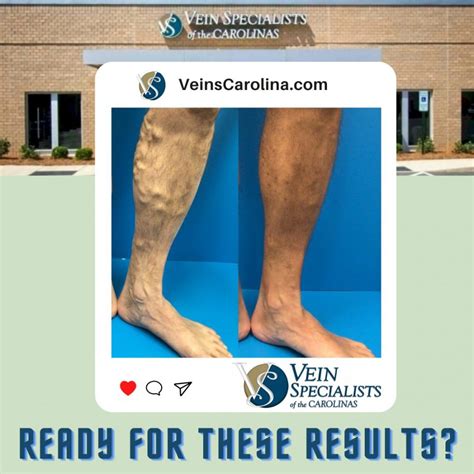 Vein Care For Women And Men Vein Specialists Of The Carolinas