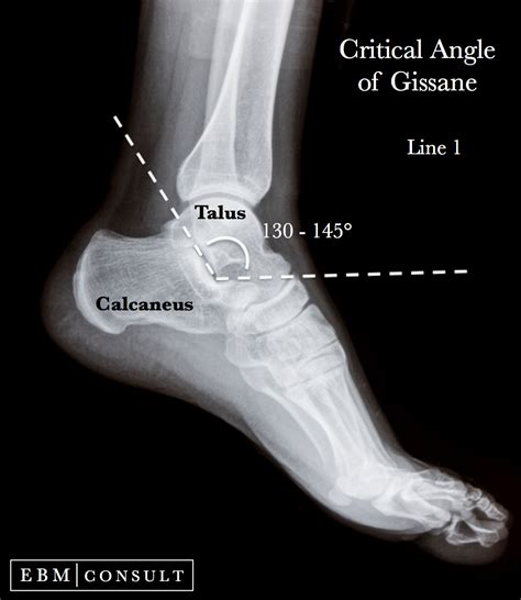 Anatomy Critical Angle Of Gissane For Calcaneus Fractures