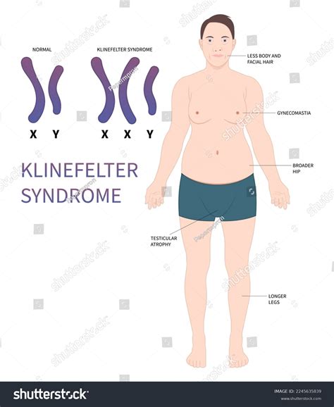 Klinefelter Syndrome Xxy Syndrome Symptoms Causes 44 Off