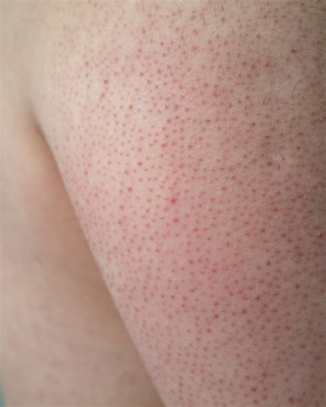 Keratosis Pilaris Under Eyes