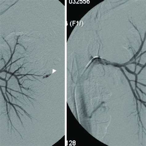 A Selective Left Renal Angiography Shows Active Extravasation Of Download Scientific Diagram