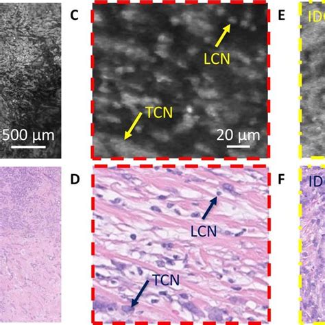 Imaging Of A Breast Tumor From The Second Patient A Uv Pam Image Of