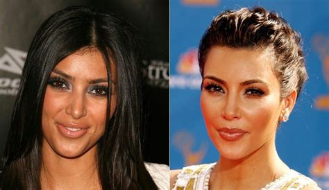 Kim Kardashian Before And After Plastic Surgery