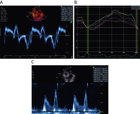 Left Atrial Strain Performance And Its Application In Clinical Practice