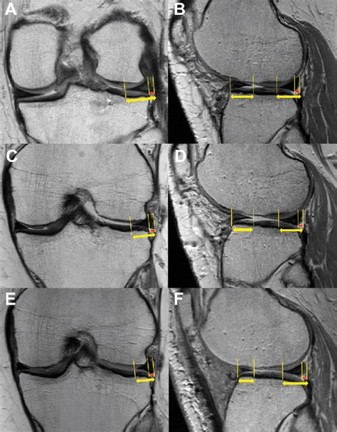 Figure 2 From Absolute Meniscal Extrusion After Lateral Meniscal Allograft Transplantation Does