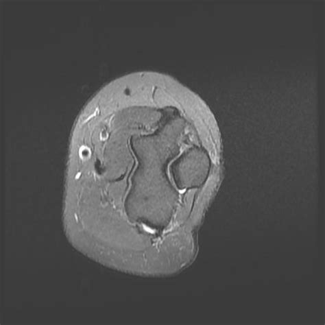 Lateral Epicondylitis Tennis Elbow Image