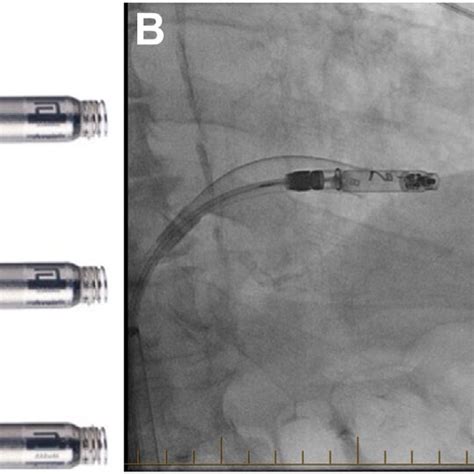 Retrieval of Aveir leadless pacemaker (LP) (Abbott Laboratories). A ...