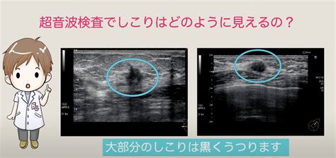 【エコー】乳房超音波検査ってどんな検査？【乳腺放射線科医が乳房エコー検査について分かりやすく解説：乳がん大事典】 ｜乳がん大事典｜bc Tube｜複数人の乳腺科医による制作・監修