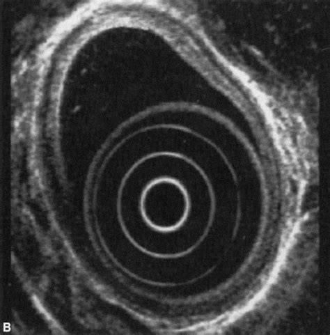 Endosonography In The Evaluation Of Patients With Barretts Esophagus