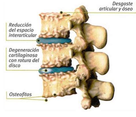 Artrosis Cervical FisioOnline