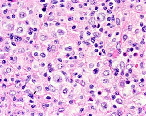 Diffuse Large B Cell Lymphoma T Cell Histiocyte Rich Variant Lymph Node 3