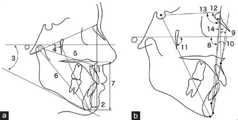 A Skeletal Hard Tissue Cephalometric Variables 1 Nasion Download Scientific Diagram