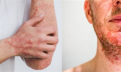 Seborrheic Dermatitis Vs Psoriasis Differences Symptoms Causes And Treatment Options