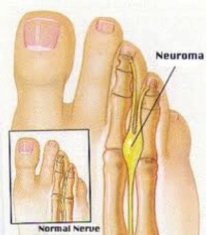 Morton S Neuroma Wikem