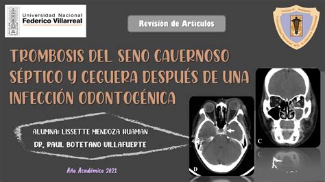 Trombosis Del Seno Cavernoso Séptico Y Ceguera Después De Una Infección Odontogénica Youtube