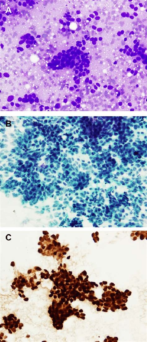 Metastatic Breast Carcinoma Of The Parotid Gland Is Observed On A A