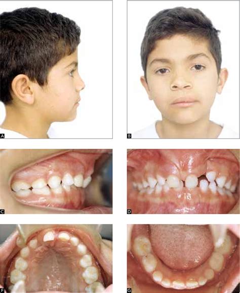 Figure From Reconstruction Of Alveolar Cleft With Allogenous Bone