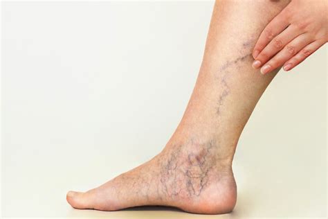 Spider Veins Causes Symptoms And Treatment Options HealthFixin