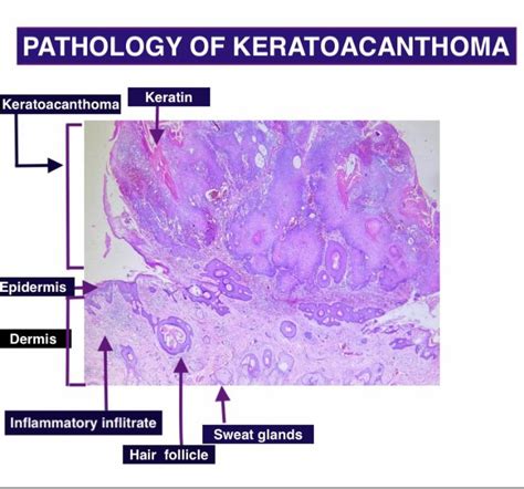 Keratoacanthoma Histology