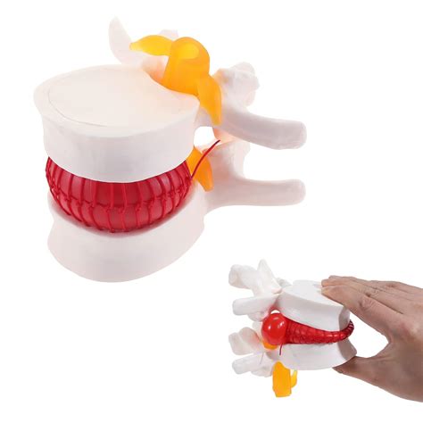 Buy Skumod Lumbar Disc Herniation Model Ideal For Teaching And Learning