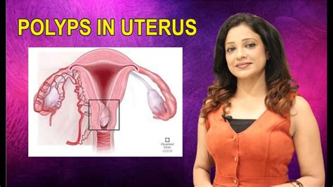 How Do Polyps Develop In Uterus How Are They Different From