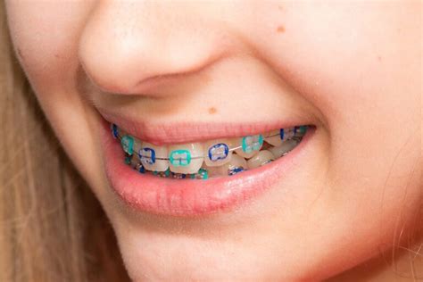 🥇 Choose the Best Colors for your Braces【 2021 】Good colors & Ideas