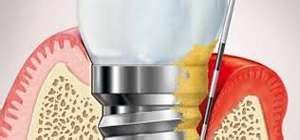 Dental Implant Infection | Signs, Causes & Treatment