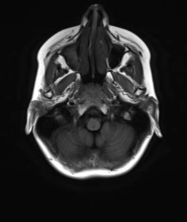 Radiopaedia Case Pericallosal Lipoma Id Study Nc Commons