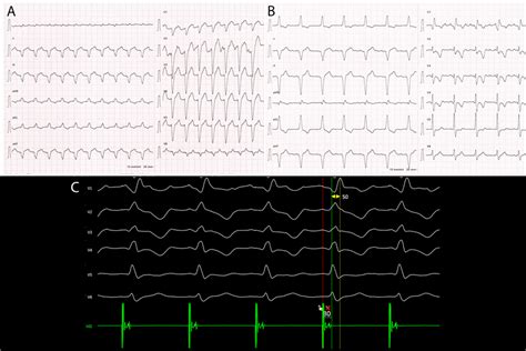 Ecg Tracings Before During And After The Procedure A A 12 Lead Ecg Download Scientific