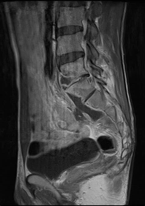 Abdominal Magnetic Resonance Imaging MRI Findings Discitis Of L5 S1