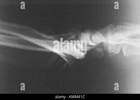 Wrist X Ray Of Comminuted Fracture Of Radius Stock Photo Alamy