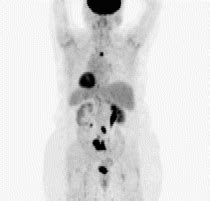 PET Scan Au FDG L Examen De TEP Par Glucose Et Fluor 18