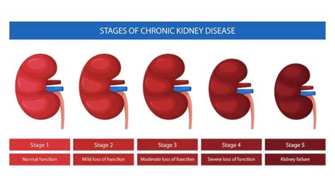 Understanding The Stages Of Chronic Kidney Disease Ckd