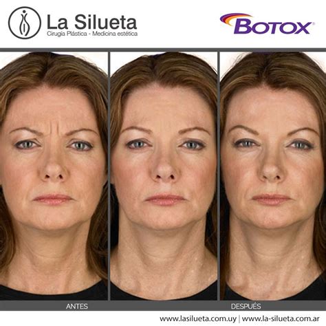 Botox Es La Marca Comercial Registrada De Toxina Botul Nica Tipo A M S