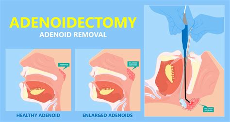 Tonsillectomy And Adenoidectomy Surgery Aglow Ent Centre