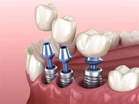 Woodland Hills Dentist Explains How We Guide Implant Placement Woodland Hills Ca