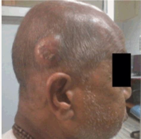 Albums 92 Pictures Photos Of Melanoma On Scalp Latest