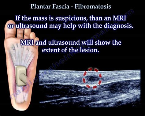 Plantar Fibromatosis