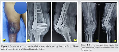 Case Of Infected Non Union Of Distal Femur Treated With Ilizarov