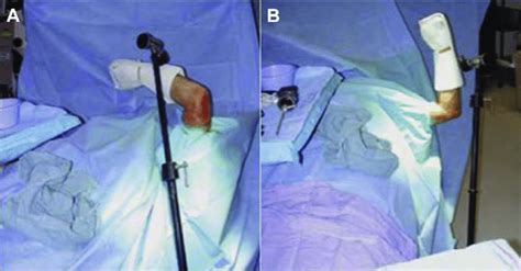 Our Preferred Patient Positioning For Elbow Arthroscopy Supine With A