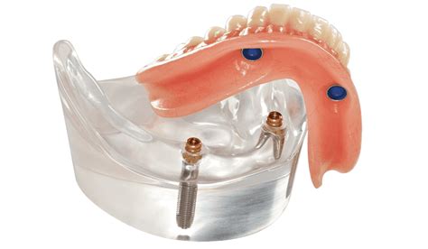 Mini Dental Implant Supported Denture