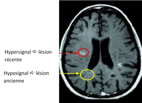 IRM cérébrales et médullaires pathologiques dans le cas d une SCLEROSE
