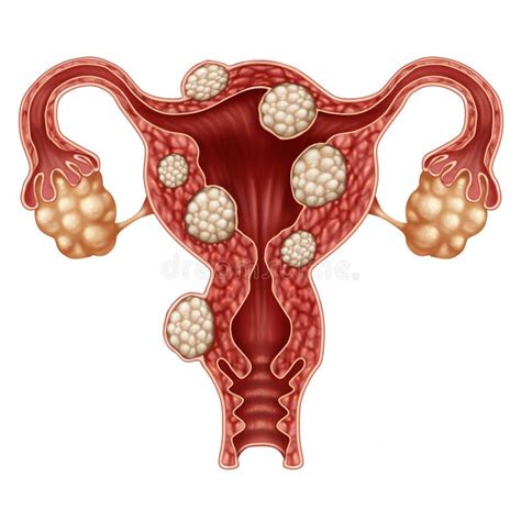 Uterine Fibroid Stock Vector Illustration Of Menstruation 29211497