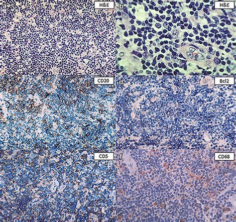 Primary Oral Cavity T Cell Histiocyte Rich Large B Cell Lymphoma A And Download Scientific