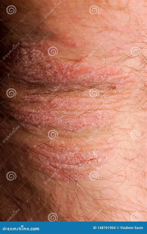 Psoriasis Dry Red and White Irritation on the Skin Closeup Stock Photo - Image of chronic ...