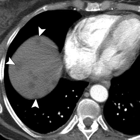 Current Update On Medullary Thyroid Carcinoma Ajr