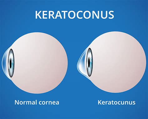 Keratoconus: Symptoms, Risk Factors, Stages, & Diagnosis | Goyal Eye