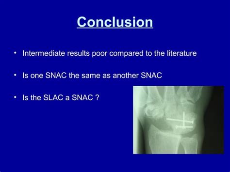 Four Corner Arthrodesis A Retrospective Review Ppt